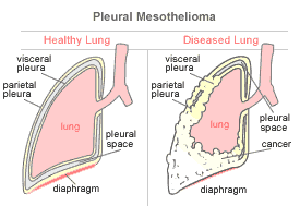 Cancer of the lung lining
