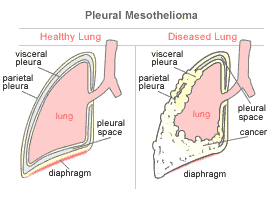 Mesothelioma Lung Cancer